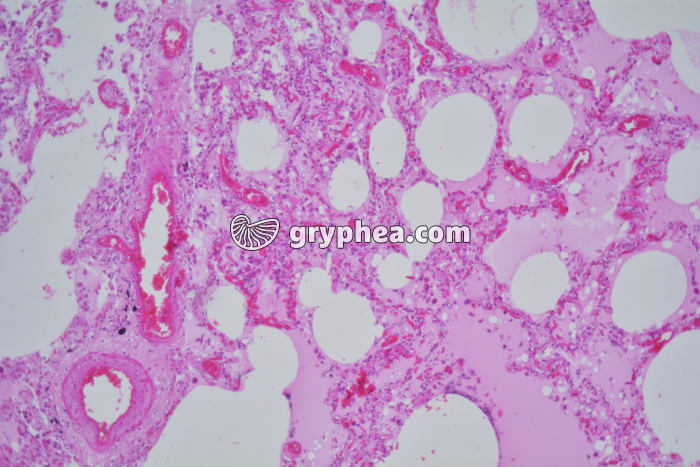 Poumon de fumeur x25 - gryphea.org